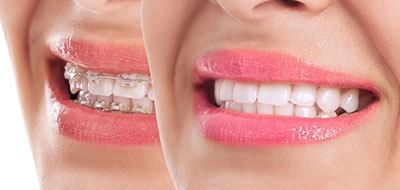 Kohn   Kollander Dental PLLC | Dental Bridges, Teeth Whitening and Ceramic Crowns