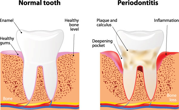 Kohn   Kollander Dental PLLC | Implant Dentistry, VELscope reg  Cancer Screening and Laser Dentistry